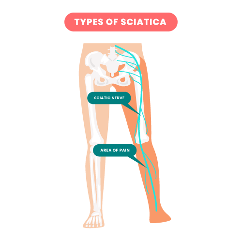 Disc, sciatica and nerve pain explain